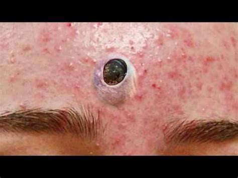 psyche0131 videos|Big Deep Blackheads And Huge Cyst Pops .